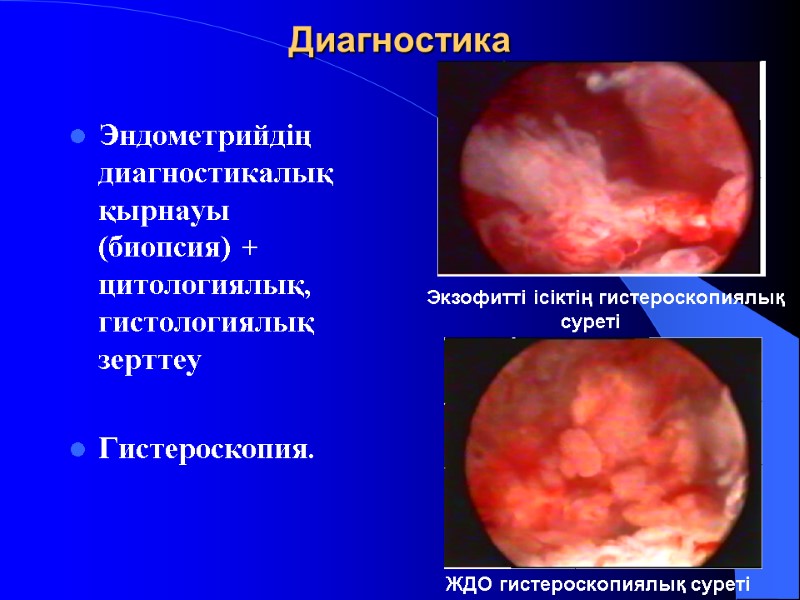 Диагностика Эндометрийдің диагностикалық қырнауы (биопсия) + цитологиялық, гистологиялық зерттеу  Гистероскопия.   Экзофитті